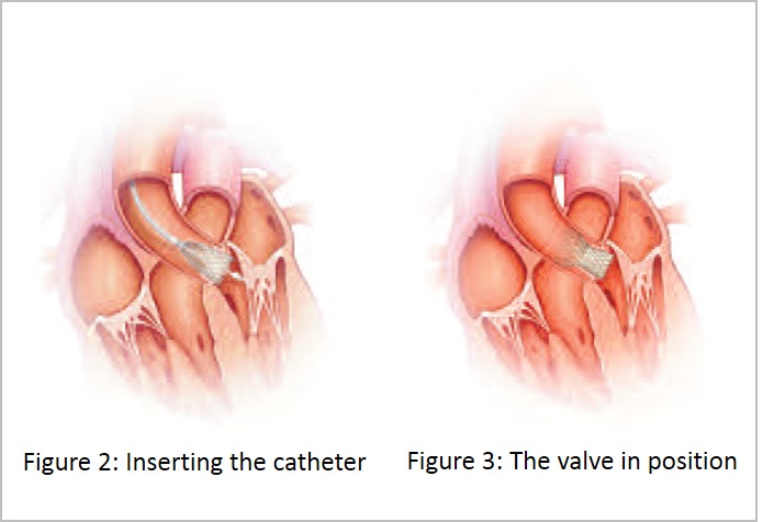 TAVI diagram 2