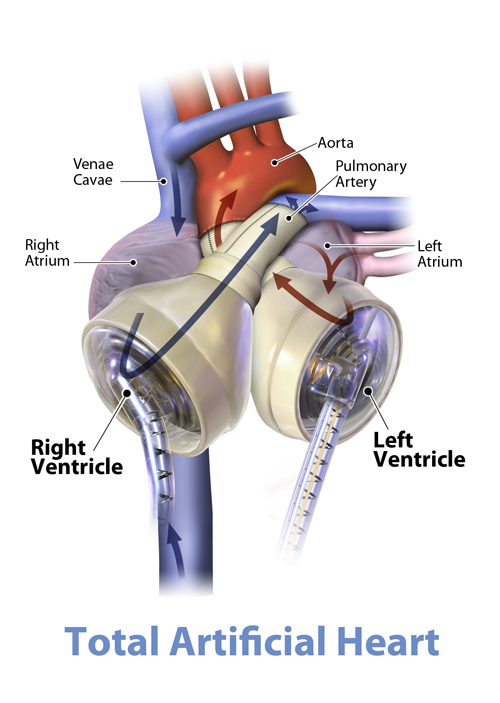 Total artificial heart example, notes clockwise from top left: Venae cavae, aorta, pulmonary artery, left atrium, left ventricle, right ventricle, right atrium