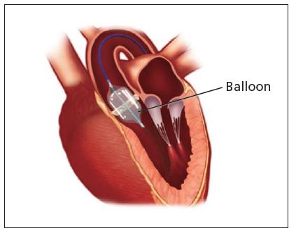 Balloon aortic valvuloplasty