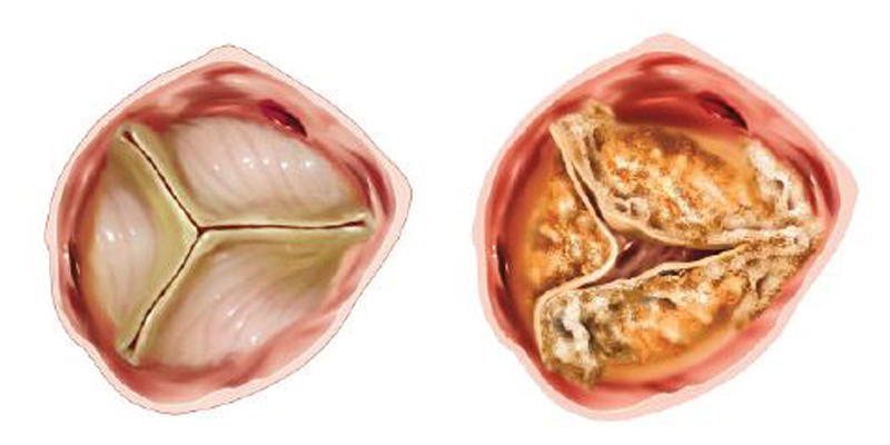 Normal aortic valve (left) and stenotic valve (right)